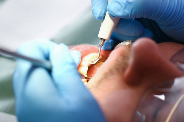 Best Emergency Root Canal Treatment in Avon, IN